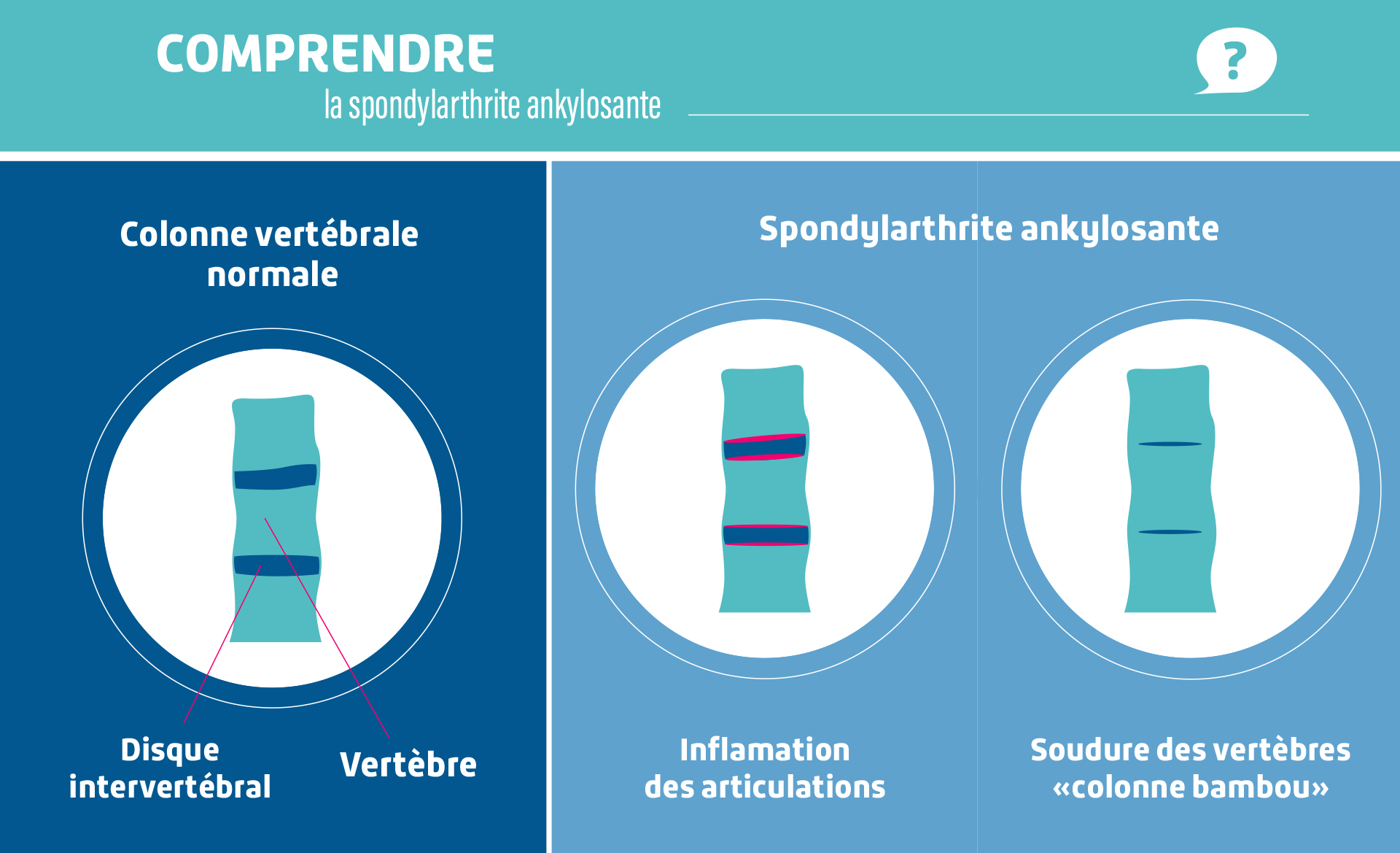 spondylarthrite