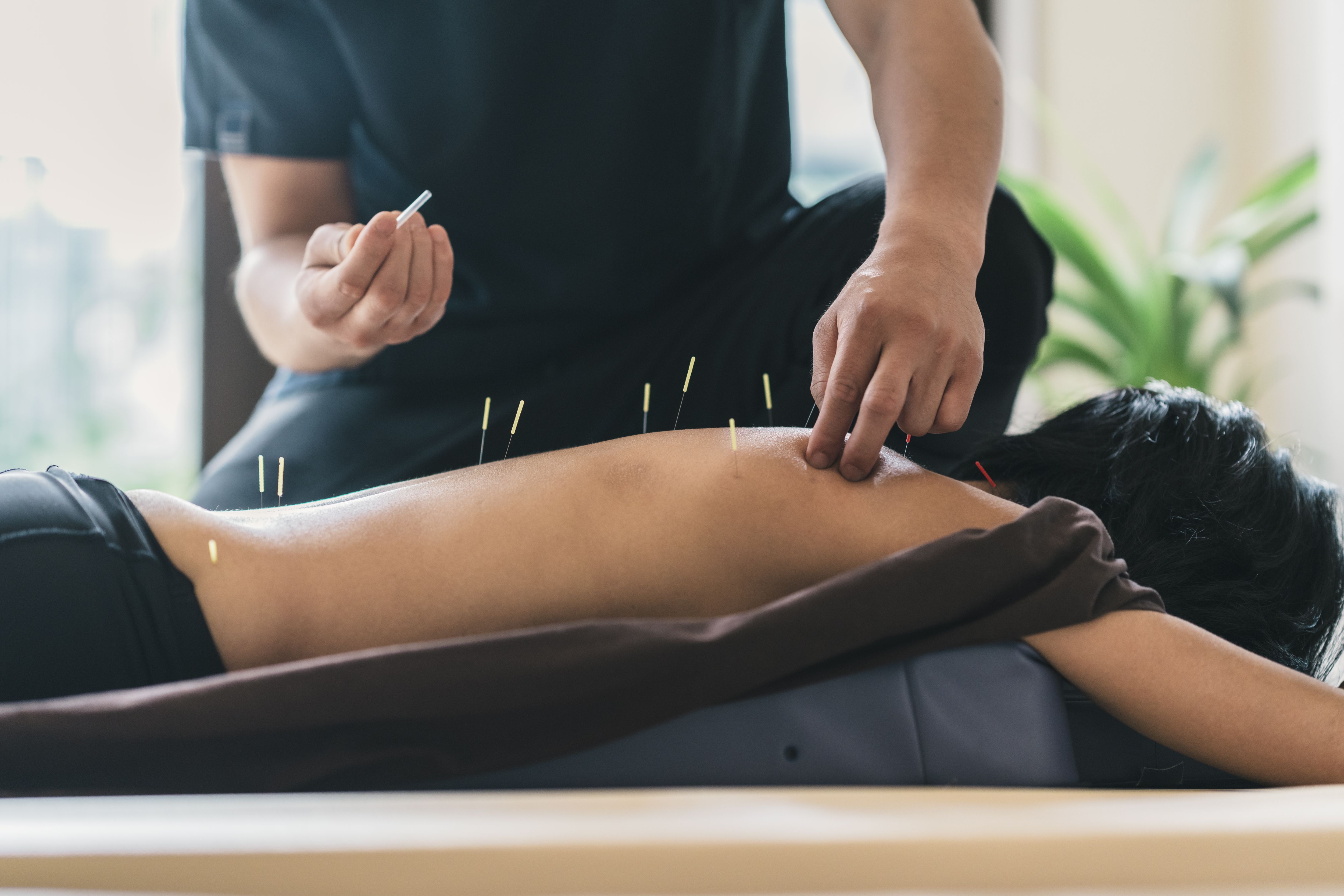 séance d'acupunture pour diminuer les douleurs dorsales