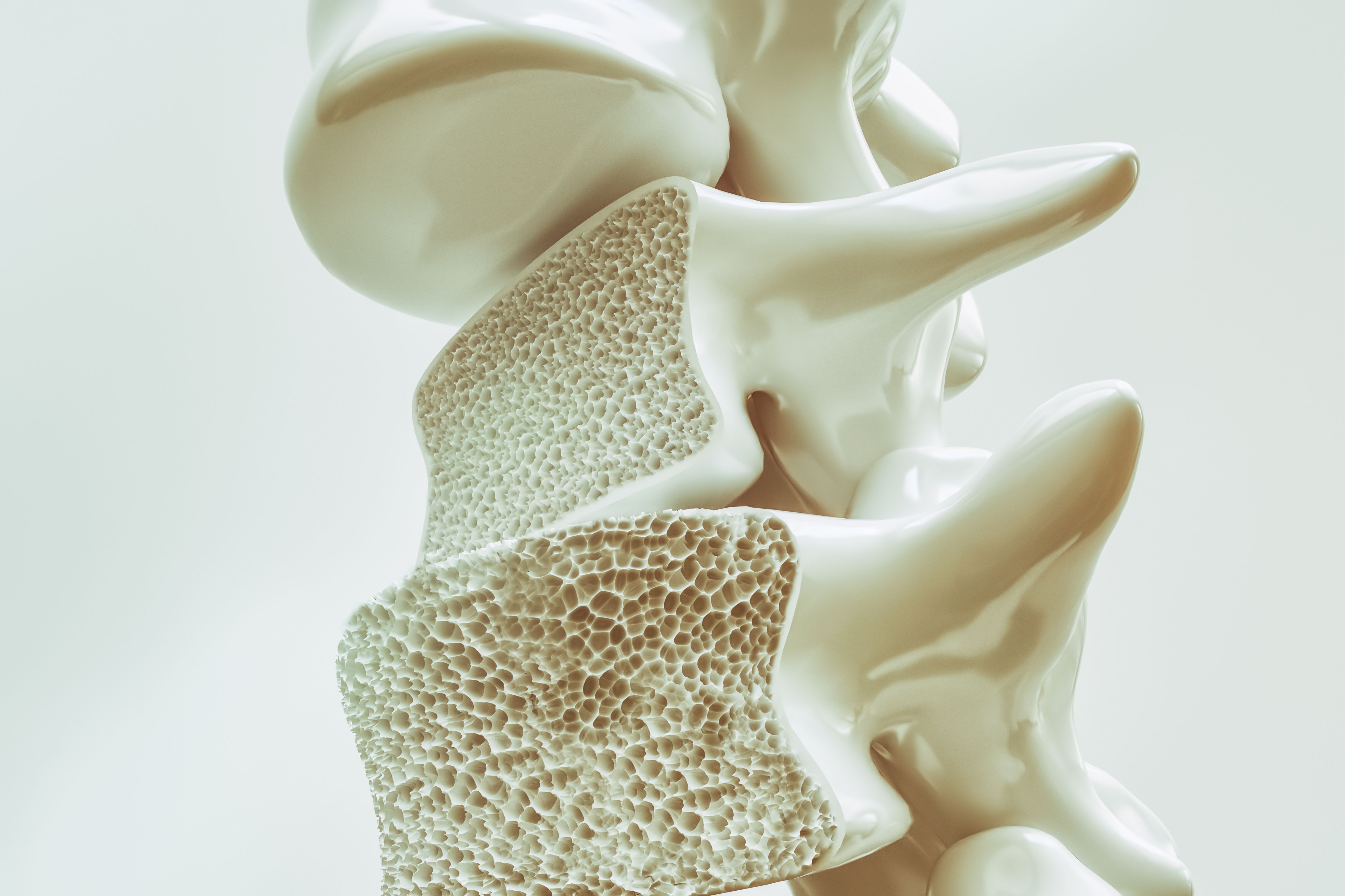 reconstitution d'un os souffrant d'ostéoporose