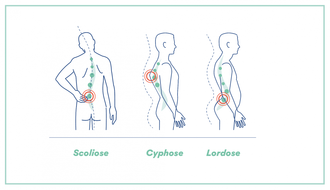 Les déformations de la colonne vertébrale